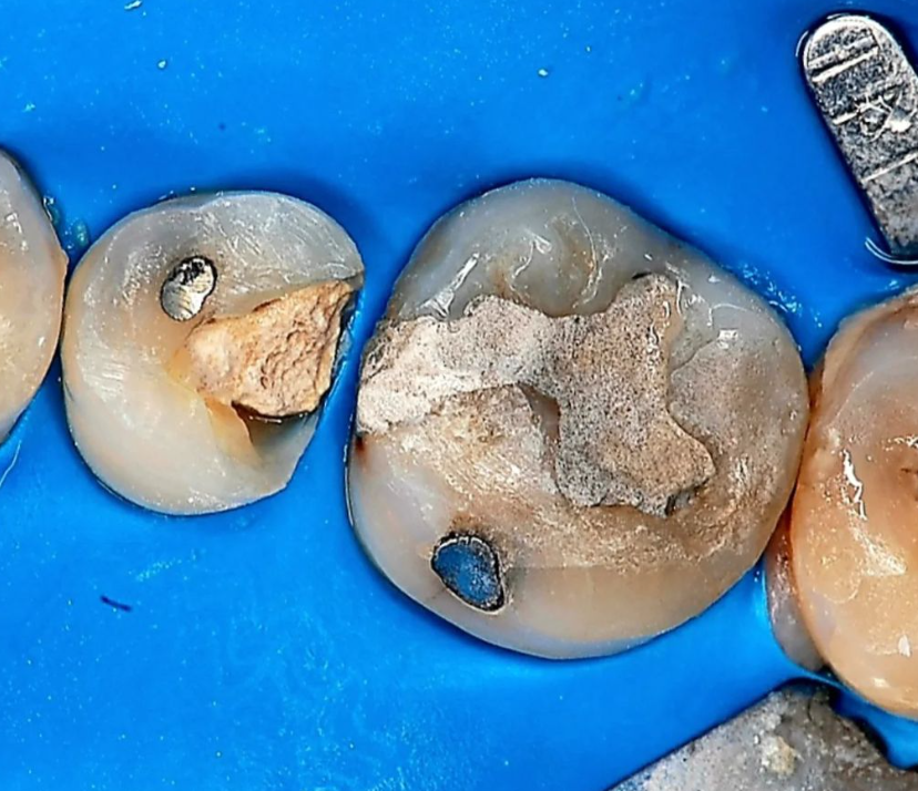 충치 치료 전 치아 모습