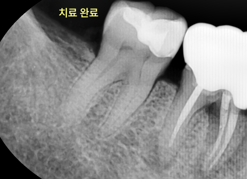 하악 좌측 어금니의 치근단 방사선 사진으로, 레진 수복이 완료된 상태
