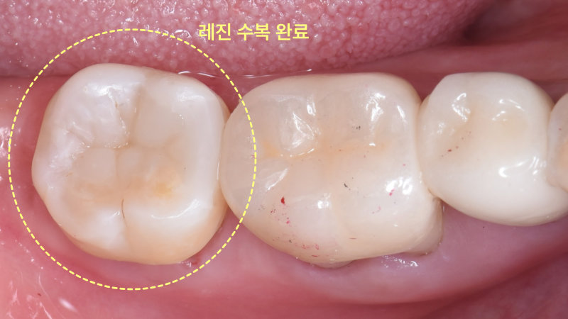 하악 좌측 어금니의 레진 수복이 완료된 구강 내 모습