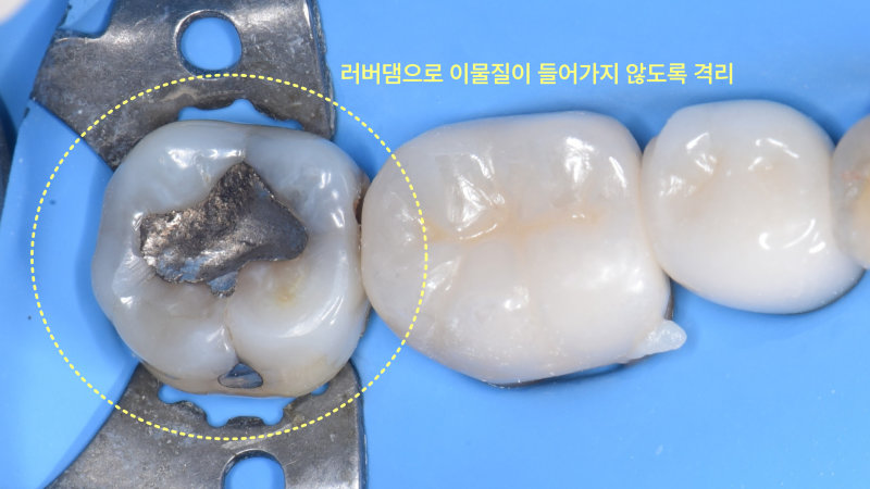 하악 좌측 어금니에 러버댐을 장착하여 치료 부위를 격리한 모습