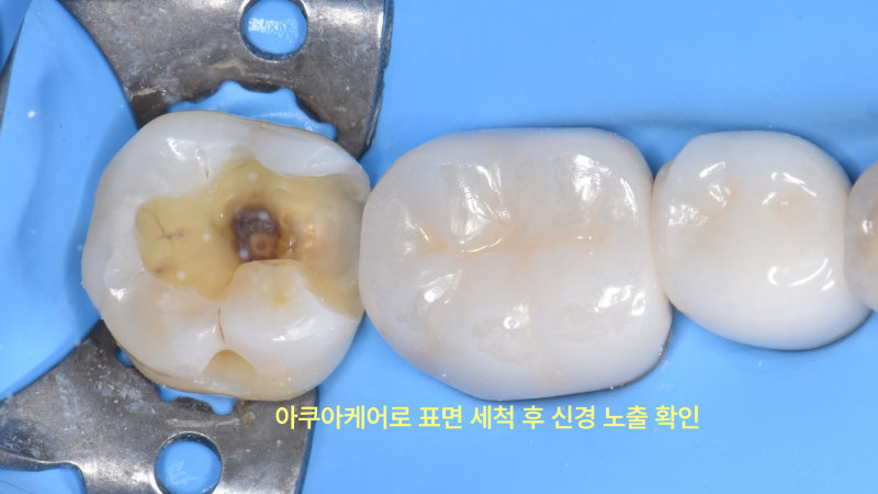 하악 좌측 어금니의 아말감 제거 후, 충치 부위를 세척한 상태에서 신경 노출이 확인되는 모습