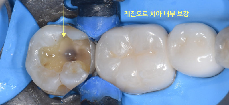 하악 좌측 어금니의 신경 노출 부위를 레진으로 보강하는 모습