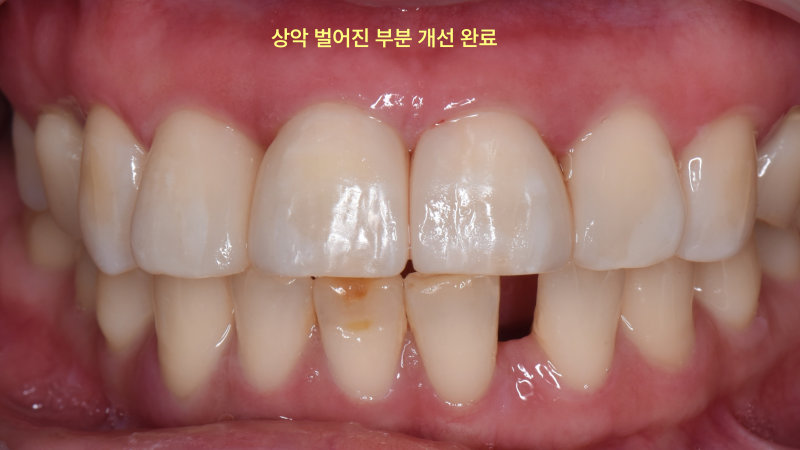 포항송도치과 벌어진 앞니, 치아 삭제 없이 레진으로 가능할까요? 관련 사진 13