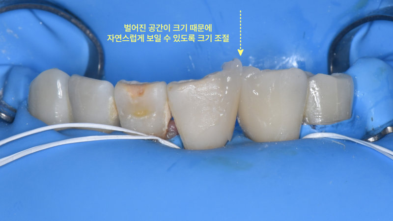 포항송도치과 벌어진 앞니, 치아 삭제 없이 레진으로 가능할까요? 관련 사진 17