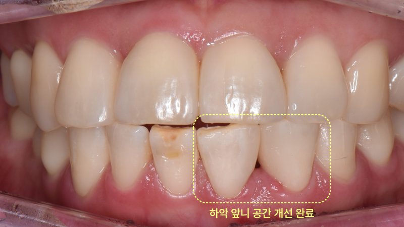 포항송도치과 벌어진 앞니, 치아 삭제 없이 레진으로 가능할까요? 관련 사진 19