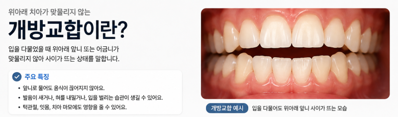포항송도치과 벌어진 앞니, 치아 삭제 없이 레진으로 가능할까요? 관련 사진 2