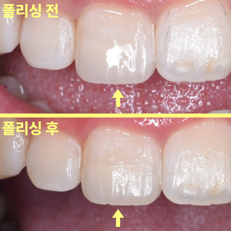 폴리싱 전후 비교 사진, 폴리싱 후 우측 앞니의 표면이 더 매끄러워짐