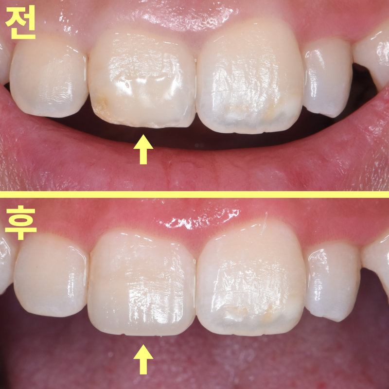 레진 치료 전후 비교 사진, 치료 후 우측 앞니의 누런 부분이 개선되고 모양이 자연스러워짐