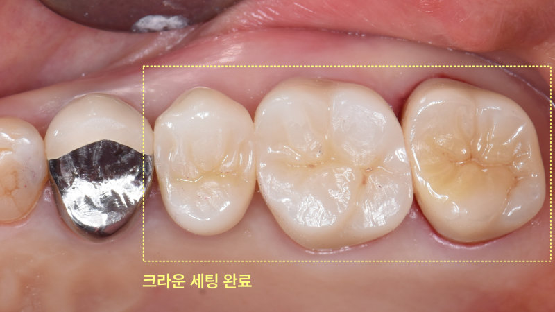 뿌리만 남은 어금니, 발치 없이 살릴 수 있을까요? 관련 사진 16