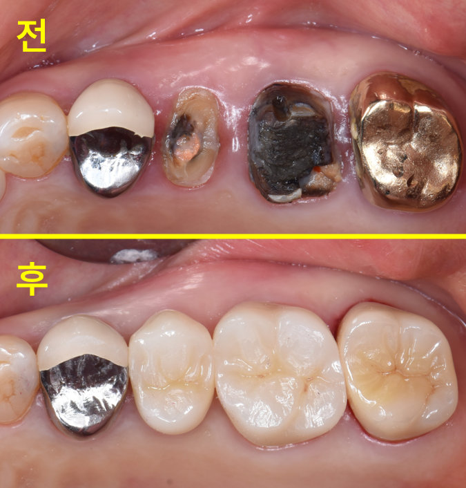 뿌리만 남은 어금니, 발치 없이 살릴 수 있을까요? 관련 사진 17