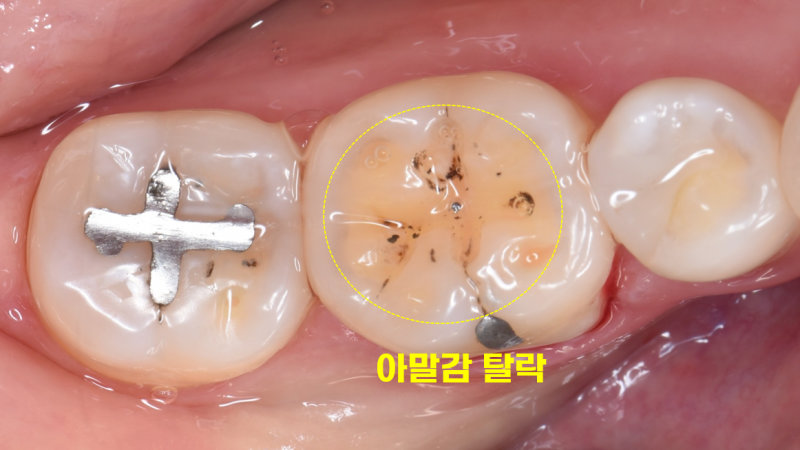 죽도동치과 아말감 깨짐, 2차 충치 위험을 막는 법 관련 사진 2