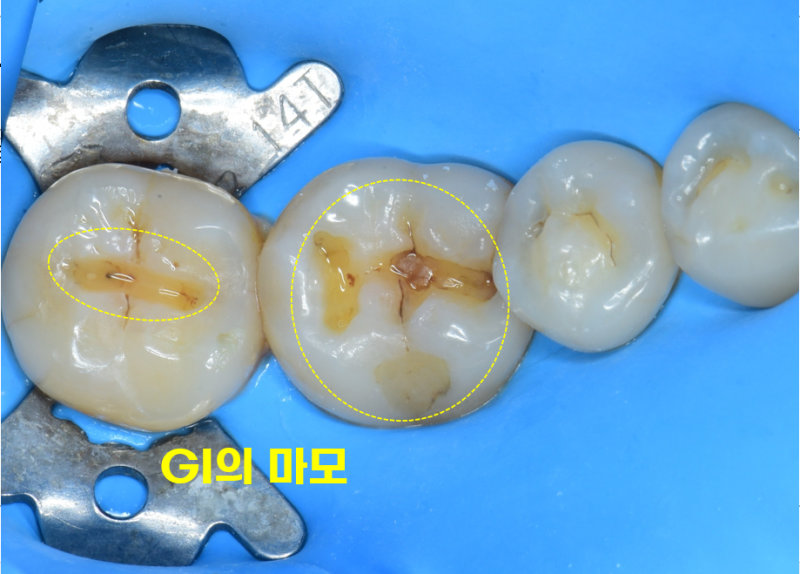 죽도동치과 아말감 깨짐, 2차 충치 위험을 막는 법 관련 사진 3