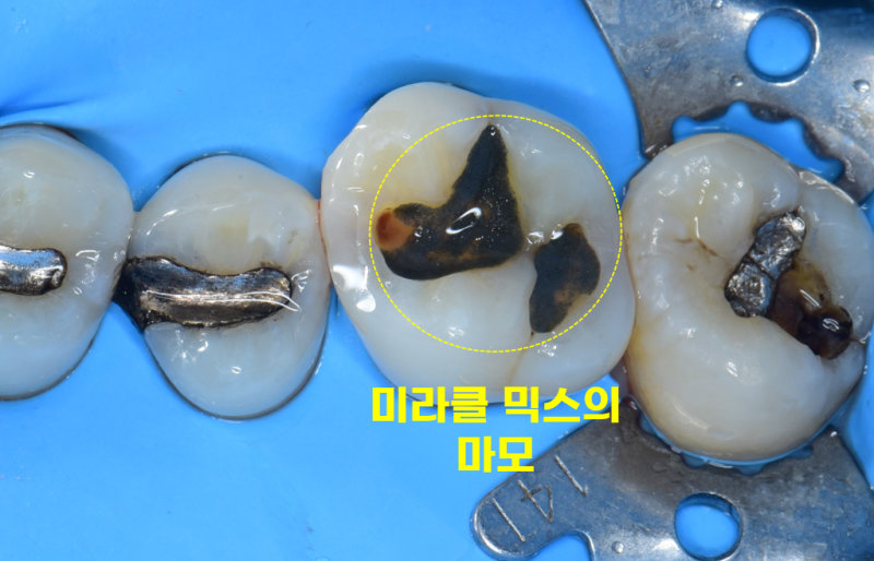 죽도동치과 아말감 깨짐, 2차 충치 위험을 막는 법 관련 사진 4
