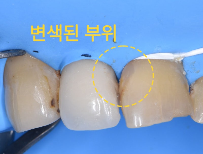 윗니 앞니 4개의 모습, 오른쪽 세 번째 치아의 변색된 부위를 노란색 점선 원으로 표시함