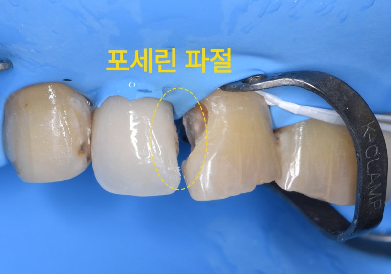 윗니 앞니 4개의 모습, 왼쪽 두 번째 치아와 오른쪽 세 번째 치아 사이의 포세린 파절 부위를 노란색 점선 원으로 표시함