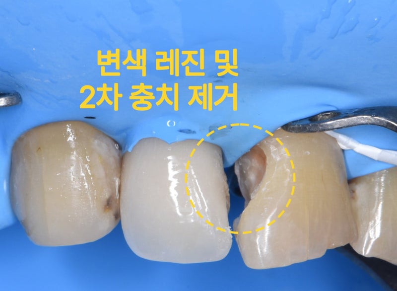 윗니 앞니 4개의 모습, 왼쪽 두 번째 치아와 오른쪽 세 번째 치아의 변색 레진 및 2차 충치 제거 부위를 노란색 점선 원으로 표시함