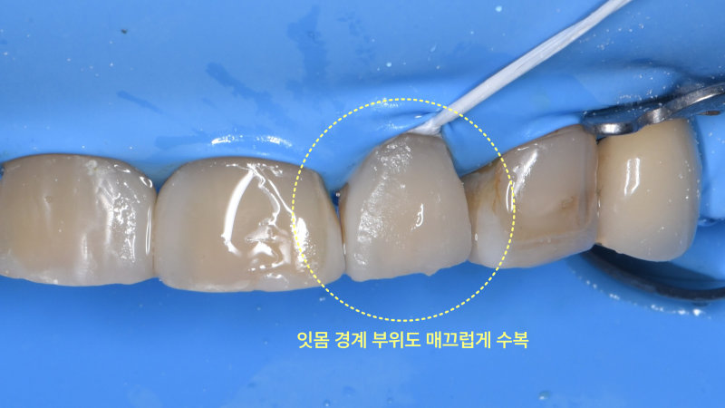 러버댐으로 격리된 상태에서 잇몸 경계 부위도 매끄럽게 수복된 모습의 구강 내 사진.