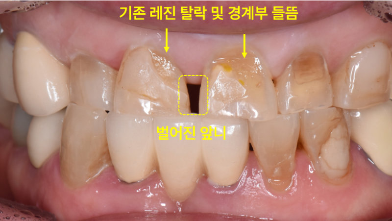 정면에서 촬영된 구강 내 사진으로, 앞니 사이가 벌어져 있고 기존 레진이 탈락하고 경계부가 들뜬 모습이 보인다.