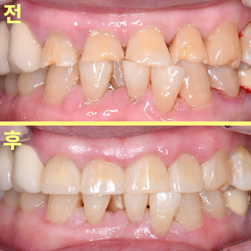 양학동치과 깨진 앞니 벌어진 틈, 레진으로 가능할까요? 관련 사진 11