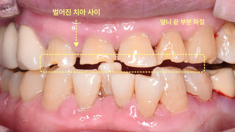 양학동치과 깨진 앞니 벌어진 틈, 레진으로 가능할까요? 관련 사진 3