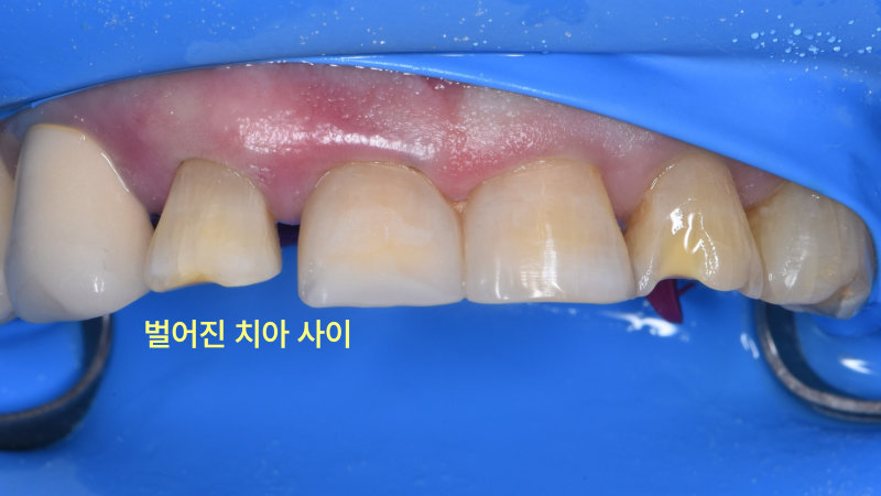 양학동치과 깨진 앞니 벌어진 틈, 레진으로 가능할까요? 관련 사진 7
