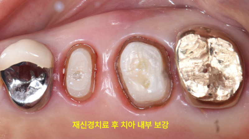 재신경치료 후 치아 내부를 보강한 구강 내 근접 촬영 사진
