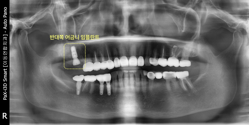 하악 우측 어금니 임플란트 식립 후 파노라마 방사선 사진