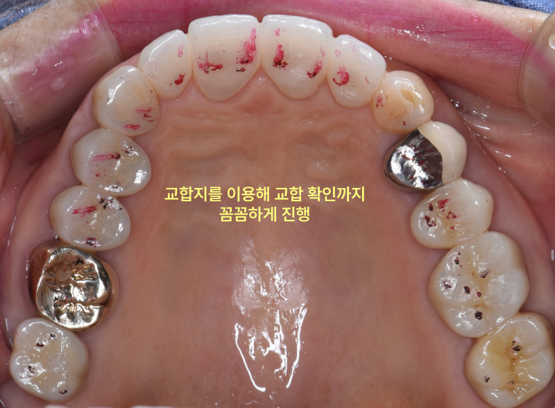 교합지를 이용하여 교합을 확인하는 구강 내 사진