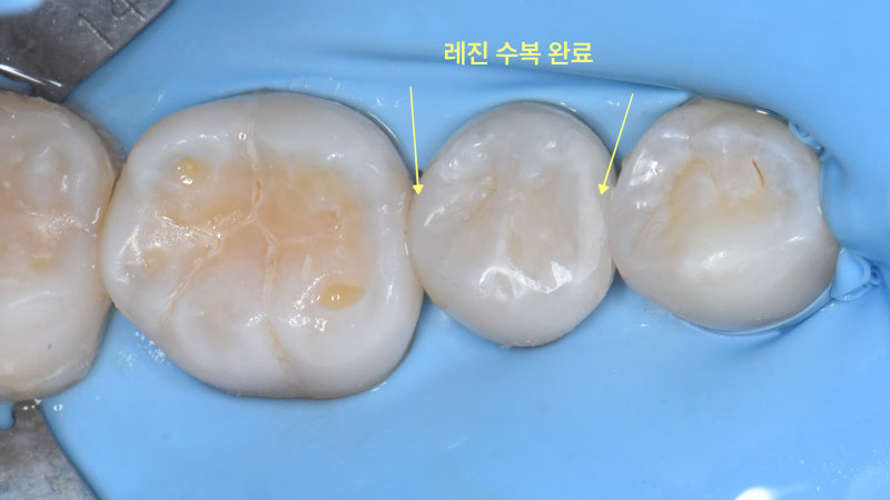 러버댐을 장착한 환자의 작은 어금니 레진 수복 완료 후 구강 내 사진