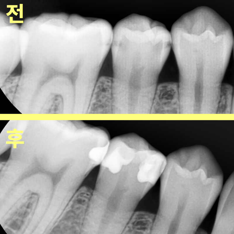 레진 수복 전후 환자의 어금니 인접면을 비교하는 치과 방사선 사진