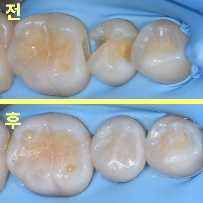 레진 수복 전후 환자의 어금니 인접면을 비교하는 구강 내 사진