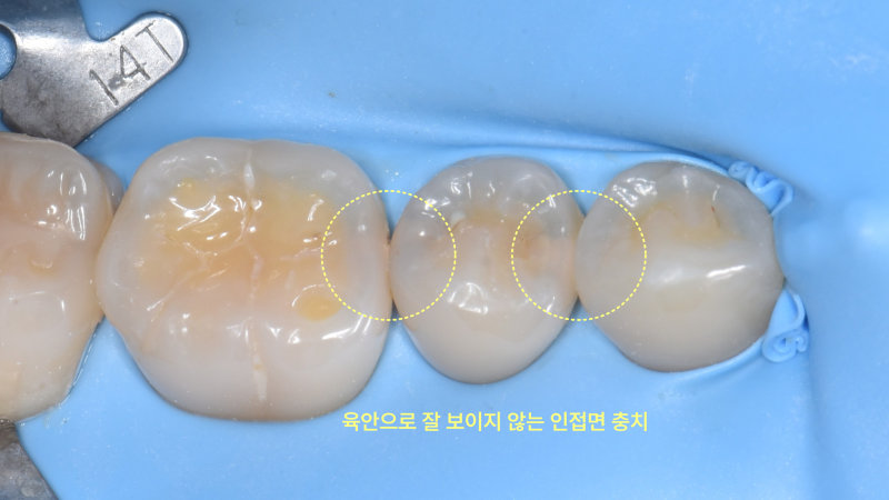 러버댐을 장착한 환자의 어금니 인접면 충치 구강 내 사진