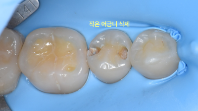 러버댐을 장착한 환자의 작은 어금니 충치 삭제 후 구강 내 사진