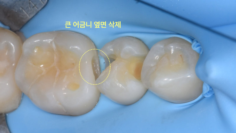러버댐을 장착한 환자의 큰 어금니 옆면 충치 삭제 후 구강 내 사진