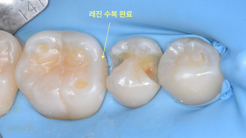 러버댐을 장착한 환자의 큰 어금니 레진 수복 완료 후 구강 내 사진