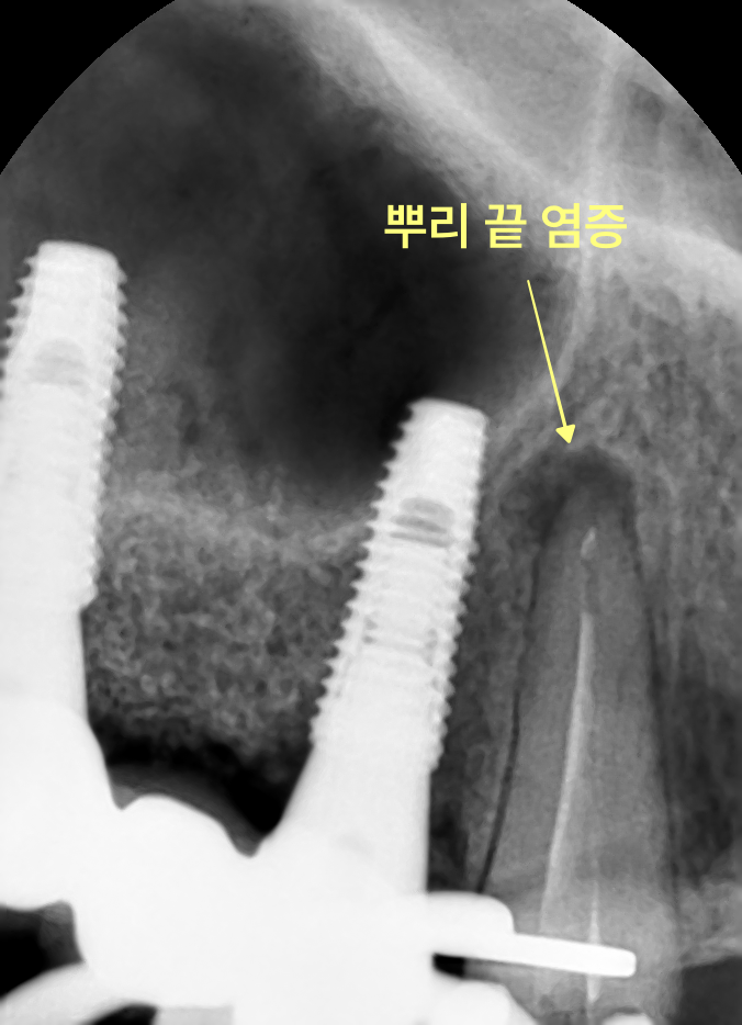 신경치료 받은 송곳니 뿌리 끝 염증을 확대한 방사선 사진