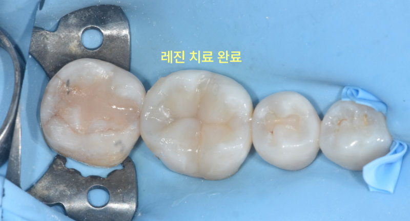레진 치료가 완료된 치아의 구강 내 확대 사진
