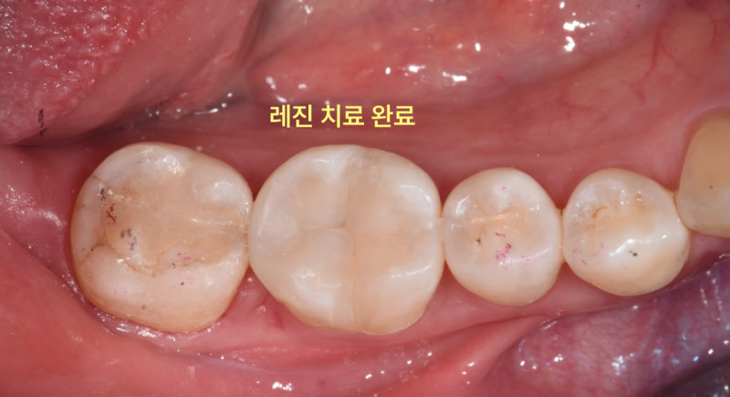 레진 치료가 완료된 치아의 구강 내 확대 사진