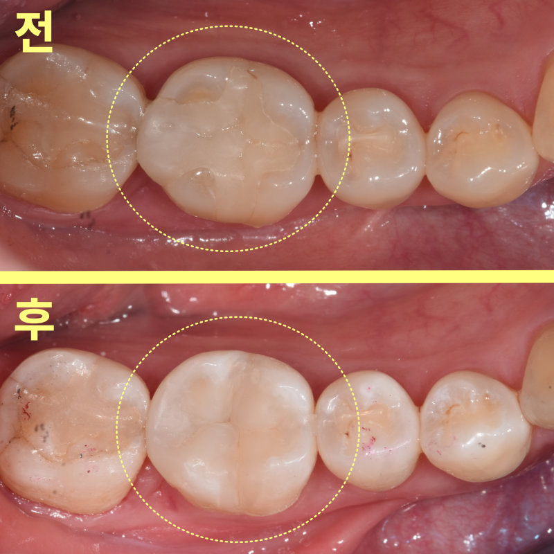 오래된 인레이가 있는 치아(전)와 레진 치료가 완료된 치아(후)의 비교 사진