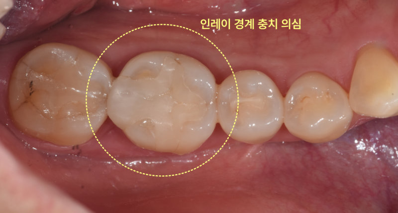 오래된 인레이 주변에 충치가 의심되는 치아의 구강 내 확대 사진