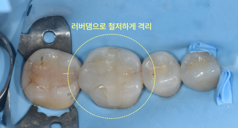러버댐으로 격리된 치아의 구강 내 확대 사진