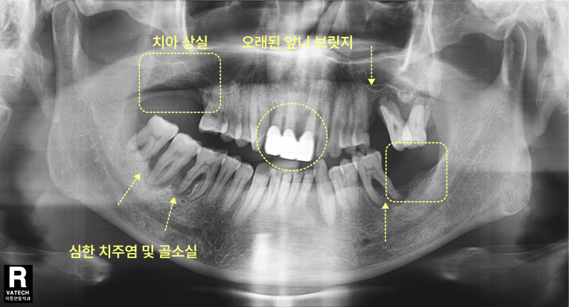 치아 상실, 오래된 앞니 브릿지, 심한 치주염 및 골손실이 표시된 파노라마 방사선 사진
