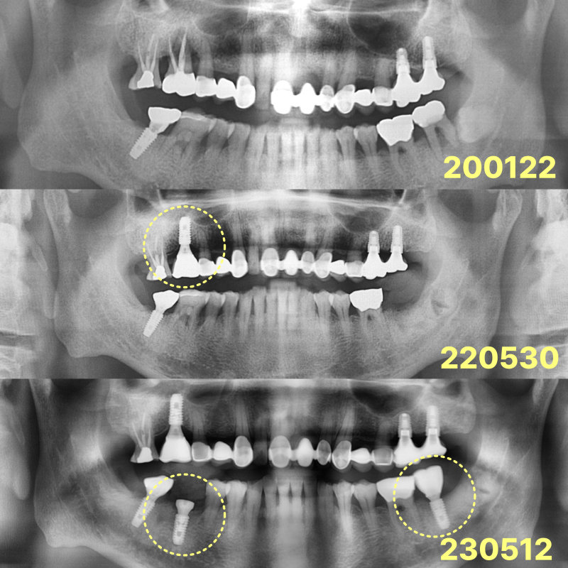 200122, 220530, 230512 날짜별 임플란트 상태 변화를 보여주는 파노라마 방사선 사진 3장