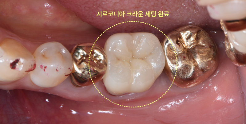 하악 좌측 어금니에 지르코니아 크라운을 세팅한 후의 모습