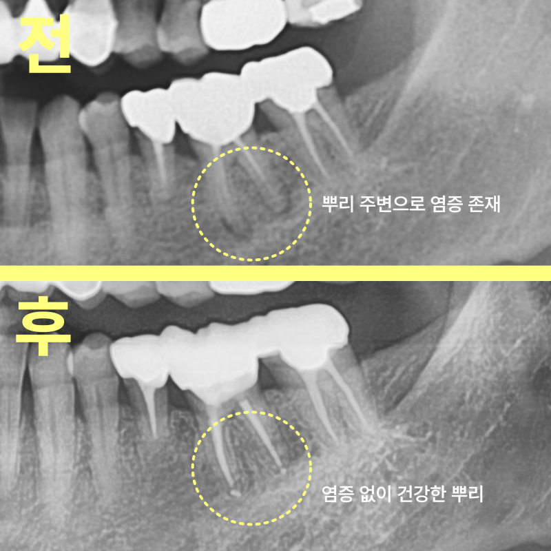 신경치료 전후 치아 뿌리 주변 염증 변화를 보여주는 치근단 방사선 사진 비교