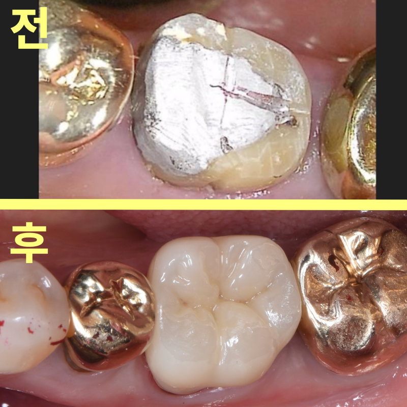 기존 아말감 충전 및 크라운과 지르코니아 크라운 세팅 후의 치아 모습 비교