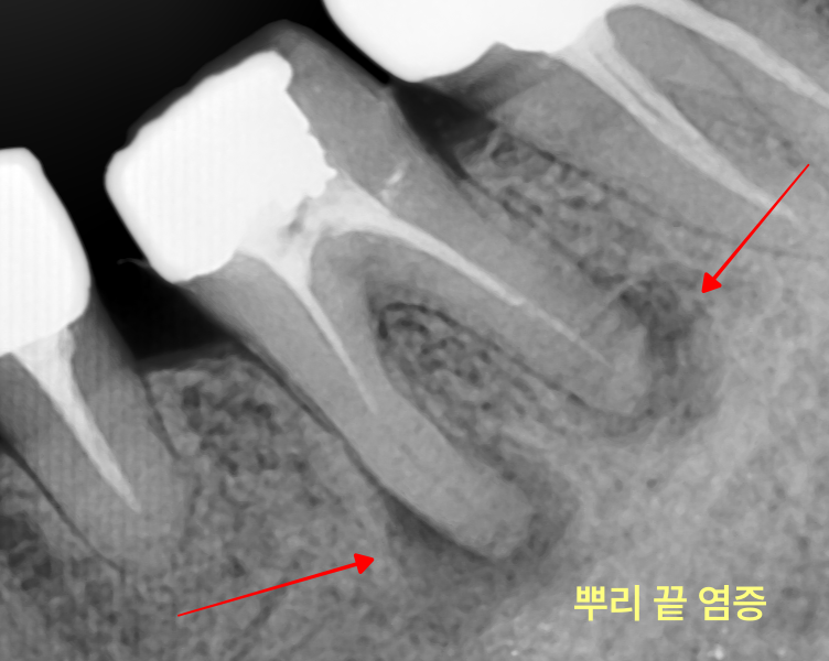 하악 좌측 어금니 뿌리 끝 염증을 확대한 치근단 방사선 사진