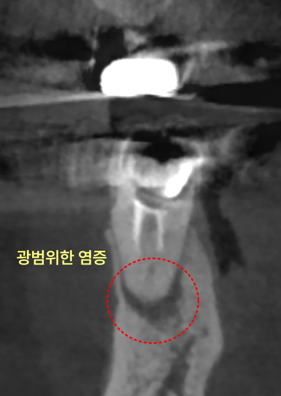 하악 좌측 어금니 뿌리 주변에 광범위한 염증이 보이는 CT 사진