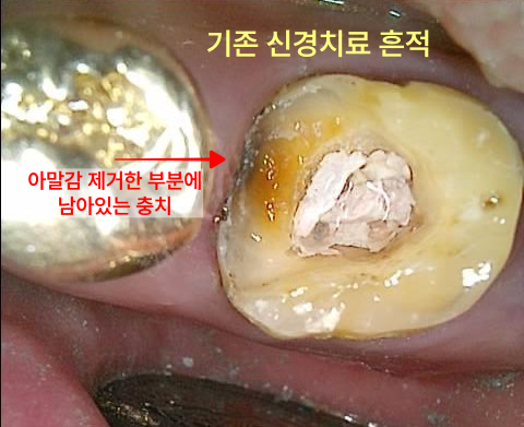 아말감 제거 후 치아 내부에 남아있는 충치와 기존 신경치료 흔적