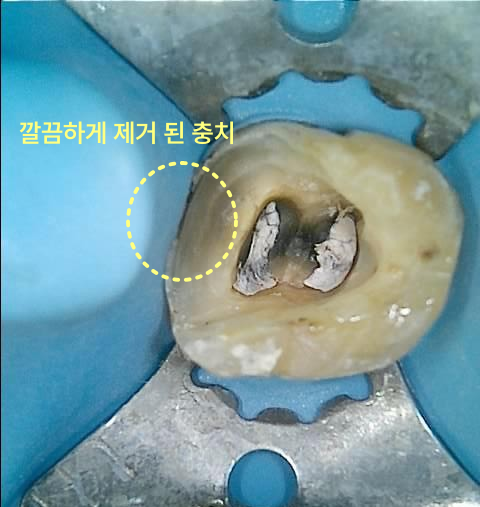 치아 내부의 충치를 깨끗하게 제거한 후의 모습